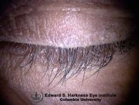 Prostaglandin-associated Hypertrichosis